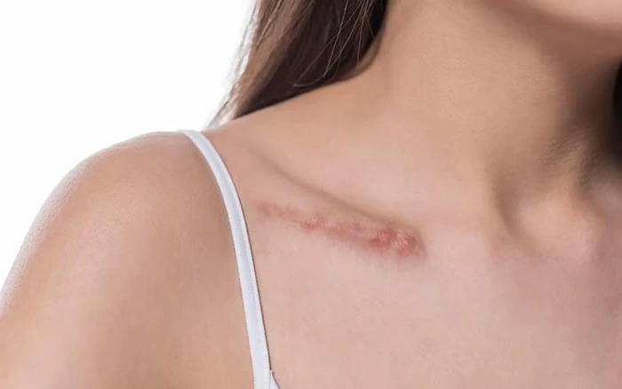 Launch of Cinoscar Product - The Perfect Scar Treatment Solution, Giving Back Confidence to Users